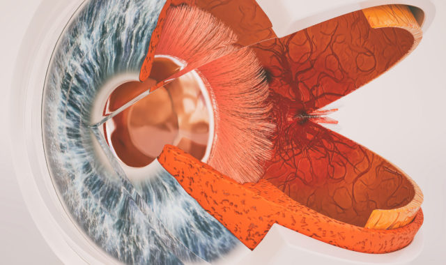 Lasik Germany erklärt: Was ist der blinde Fleck?