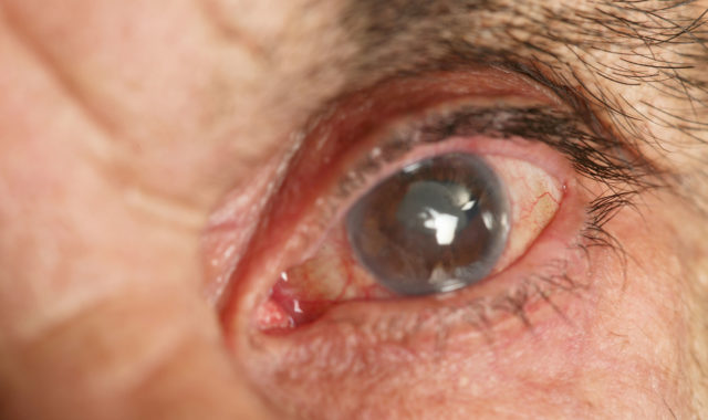 Lasik Germany über den Grauen Star (Katarakt)